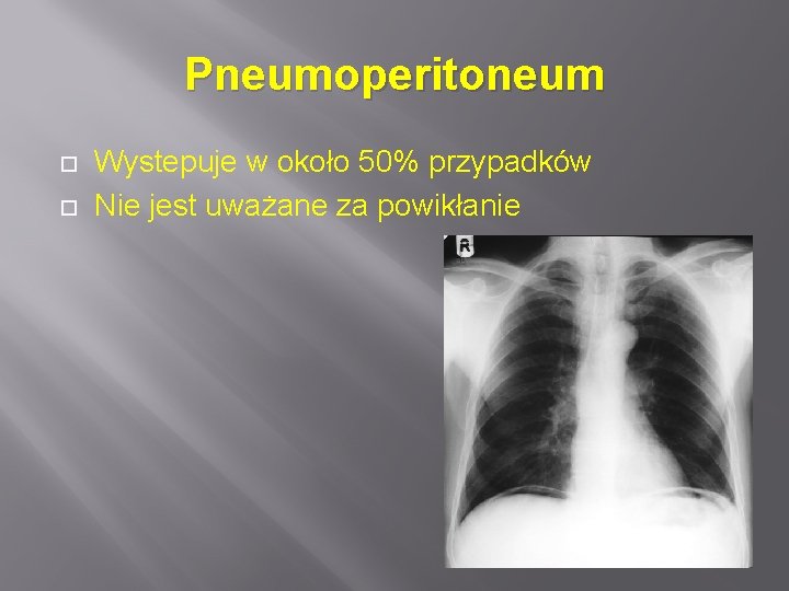 Pneumoperitoneum Wystepuje w około 50% przypadków Nie jest uważane za powikłanie 