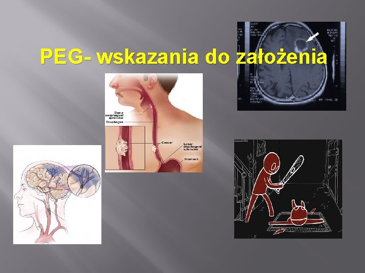 PEG- wskazania do założenia 