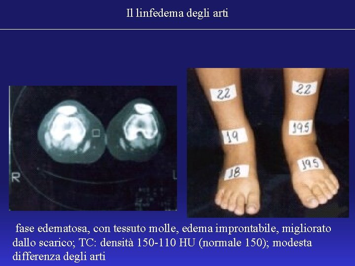 Il linfedema degli arti fase edematosa, con tessuto molle, edema improntabile, migliorato dallo scarico;