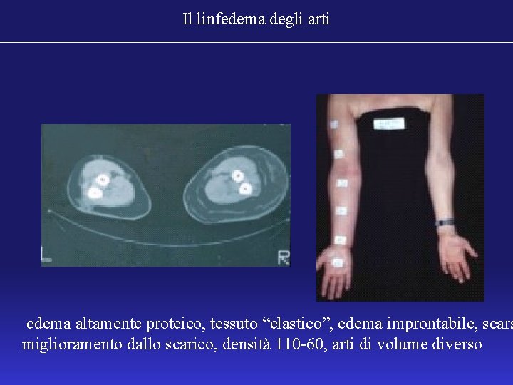 Il linfedema degli arti edema altamente proteico, tessuto “elastico”, edema improntabile, scars miglioramento dallo