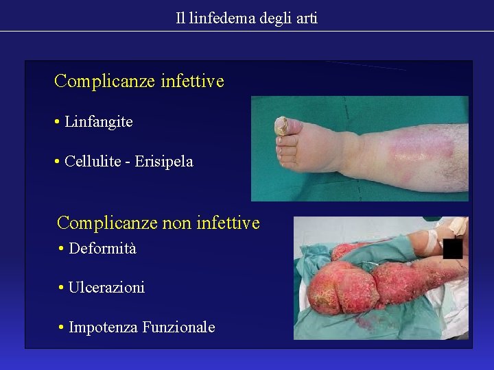 Il linfedema degli arti Complicanze infettive • Linfangite • Cellulite - Erisipela Complicanze non