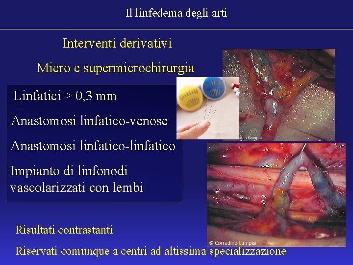 Il linfedema degli arti Interventi derivativi Micro e supermicrochirurgia Linfatici > 0, 3 mm