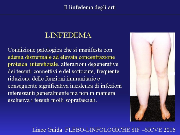 Il linfedema degli arti LINFEDEMA Condizione patologica che si manifesta con edema distrettuale ad