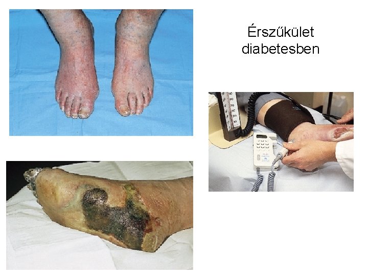 A diabeteses láb klinikuma és a microangiopathia patogenezise