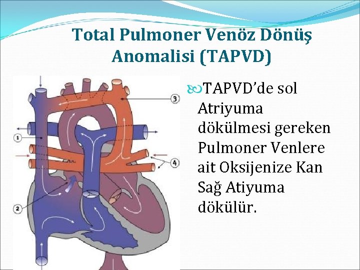Total Pulmoner Venöz Dönüş Anomalisi (TAPVD) TAPVD’de sol Atriyuma dökülmesi gereken Pulmoner Venlere ait