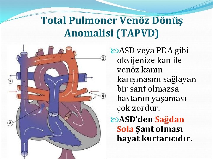 Total Pulmoner Venöz Dönüş Anomalisi (TAPVD) ASD veya PDA gibi oksijenize kan ile venöz