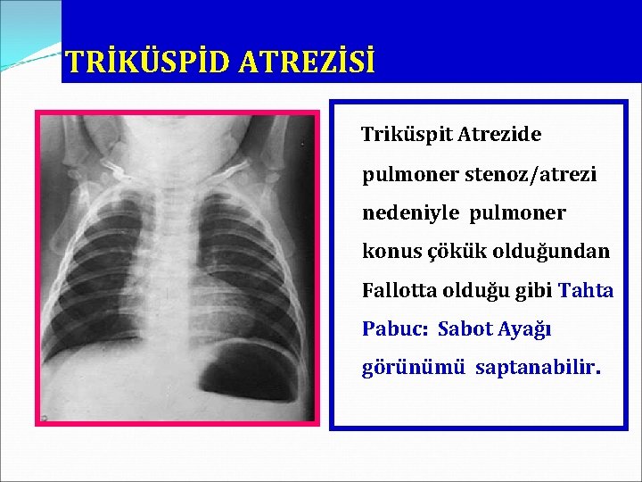 TRİKÜSPİD ATREZİSİ Triküspit Atrezide pulmoner stenoz/atrezi nedeniyle pulmoner konus çökük olduğundan Fallotta olduğu gibi