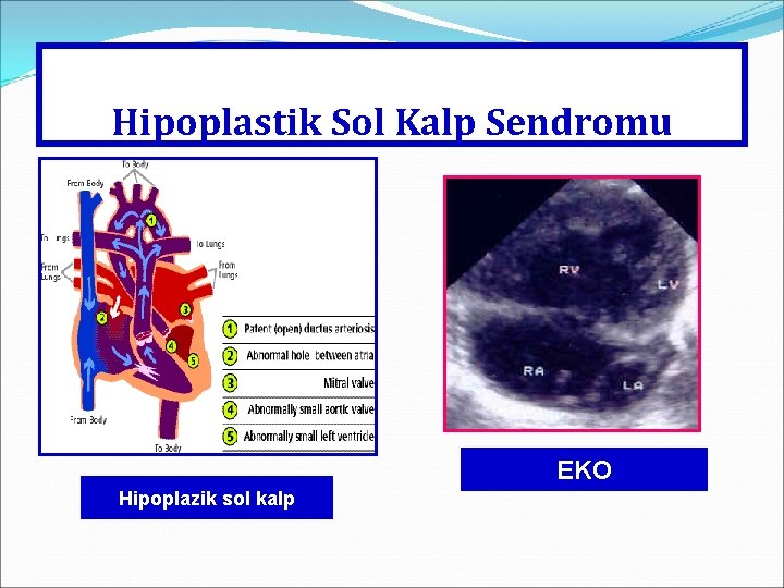 Hipoplastik Sol Kalp Sendromu EKO Hipoplazik sol kalp 