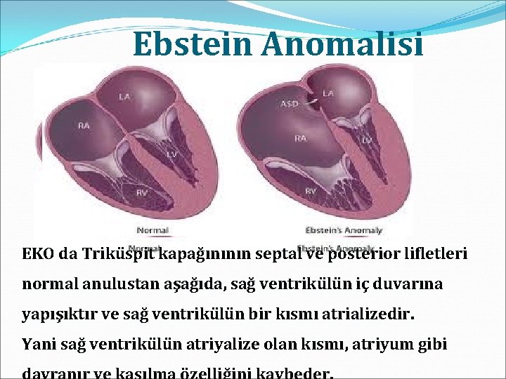 Ebstein Anomalisi EKO da Triküspit kapağınının septal ve posterior lifletleri normal anulustan aşağıda, sağ