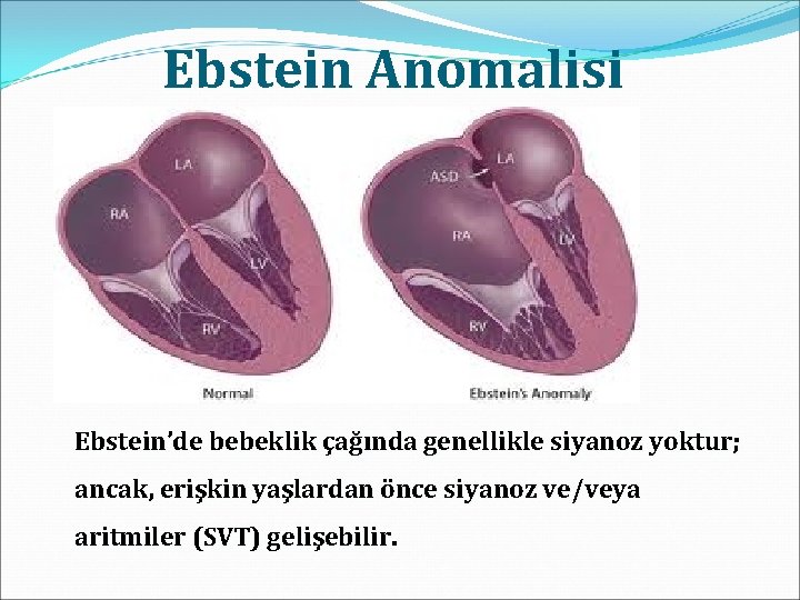 Ebstein Anomalisi Ebstein’de bebeklik çağında genellikle siyanoz yoktur; ancak, erişkin yaşlardan önce siyanoz ve/veya