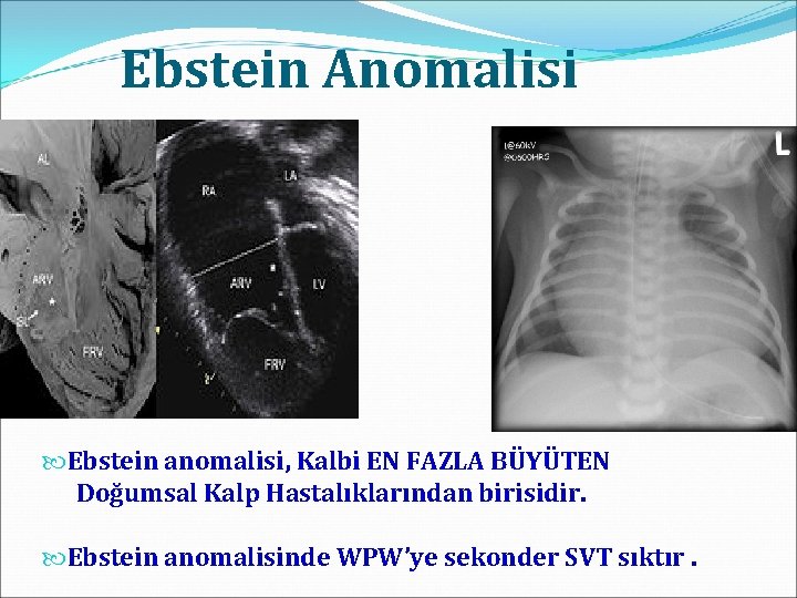 Ebstein Anomalisi Ebstein anomalisi, Kalbi EN FAZLA BÜYÜTEN Doğumsal Kalp Hastalıklarından birisidir. Ebstein anomalisinde