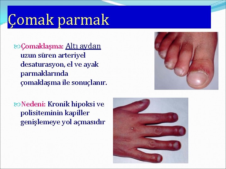Çomak parmak Çomaklaşma: Altı aydan uzun süren arteriyel desaturasyon, el ve ayak parmaklarında çomaklaşma