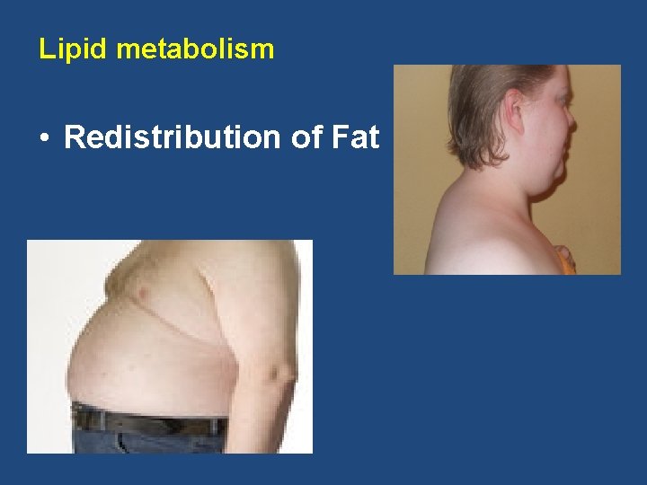 Lipid metabolism • Redistribution of Fat 