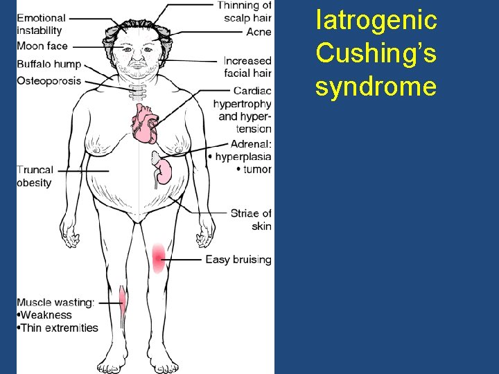 Iatrogenic Cushing’s syndrome 