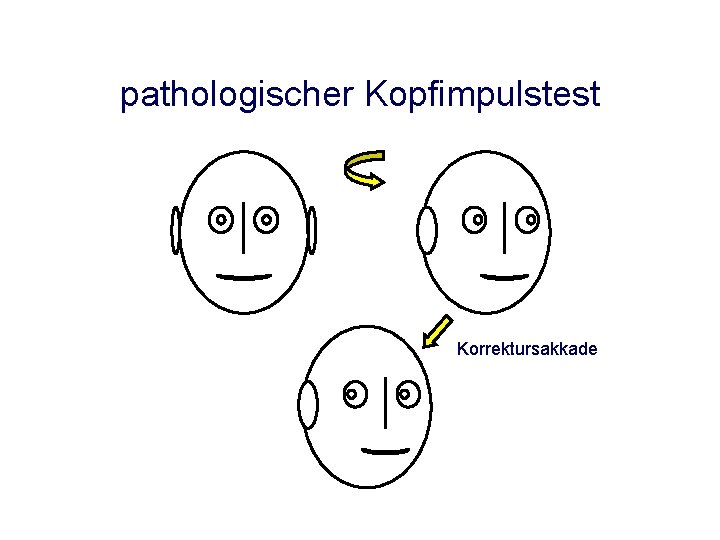 pathologischer Kopfimpulstest Korrektursakkade pathologischer Kopfimpulstest Korrektursakkade