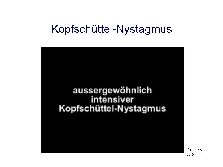 Kopfschüttel-Nystagmus Courtesy A. Schade Kopfschüttel-Nystagmus Courtesy A. Schade
