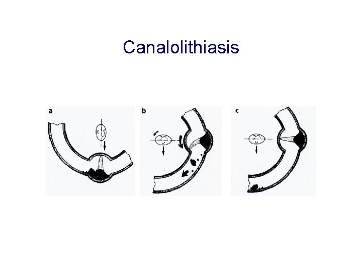 Canalolithiasis Canalolithiasis
