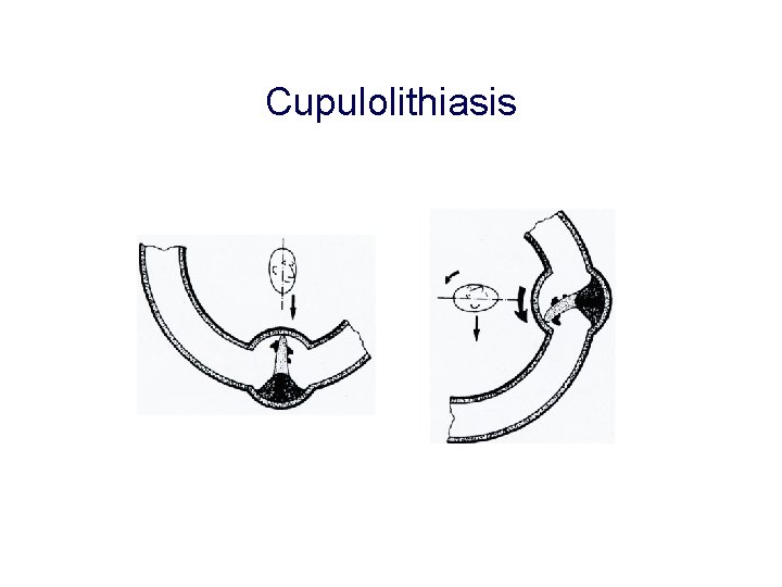 Cupulolithiasis Cupulolithiasis
