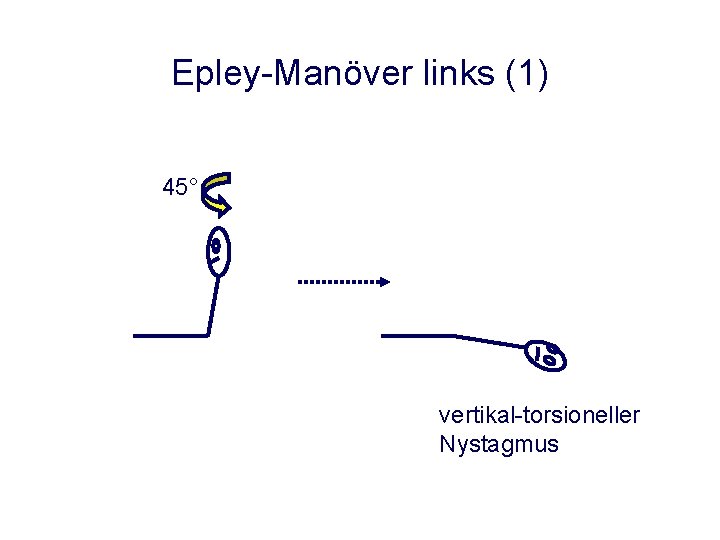 Epley-Manöver links (1) 45° vertikal-torsioneller Nystagmus Epley-Manöver links (1) 45° vertikal-torsioneller Nystagmus