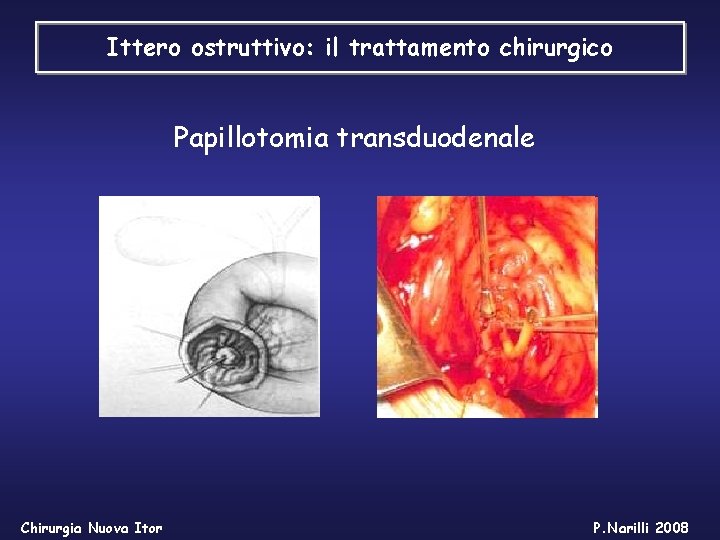 Ittero ostruttivo: il trattamento chirurgico Papillotomia transduodenale Chirurgia Nuova Itor P. Narilli 2008 