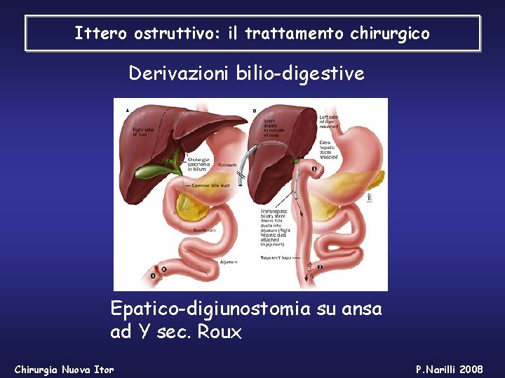 Ittero ostruttivo: il trattamento chirurgico Derivazioni bilio-digestive Epatico-digiunostomia su ansa ad Y sec. Roux