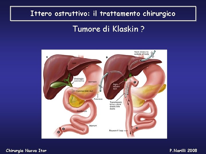 Ittero ostruttivo: il trattamento chirurgico Tumore di Klaskin ? Chirurgia Nuova Itor P. Narilli