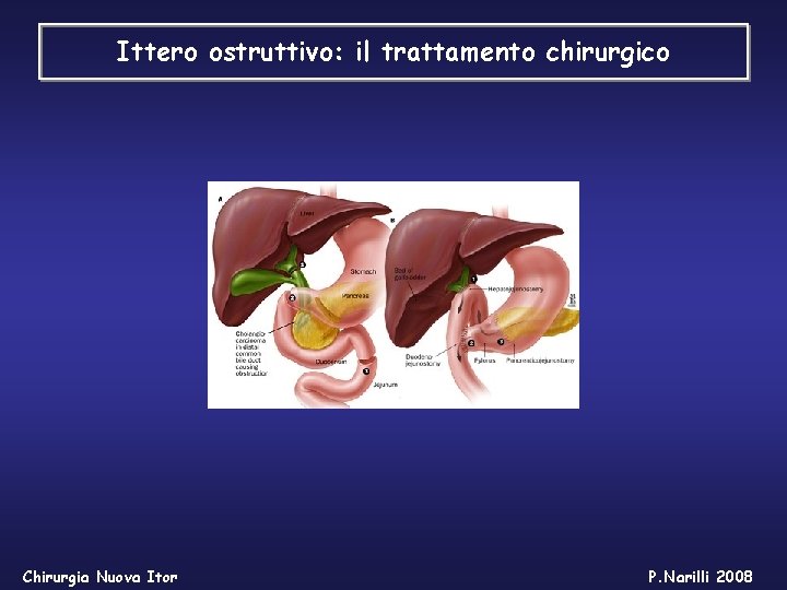 Ittero ostruttivo: il trattamento chirurgico Chirurgia Nuova Itor P. Narilli 2008 