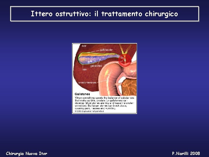 Ittero ostruttivo: il trattamento chirurgico Chirurgia Nuova Itor P. Narilli 2008 