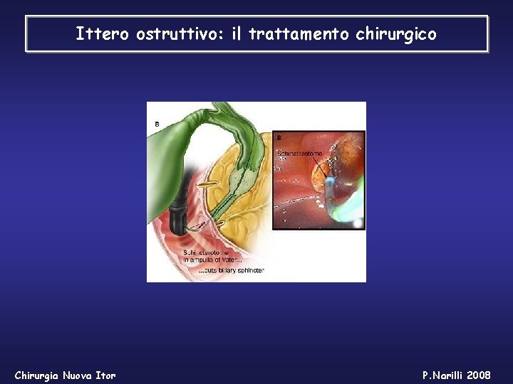 Ittero ostruttivo: il trattamento chirurgico Chirurgia Nuova Itor P. Narilli 2008 Ittero ostruttivo: il trattamento chirurgico Chirurgia Nuova Itor P. Narilli 2008
