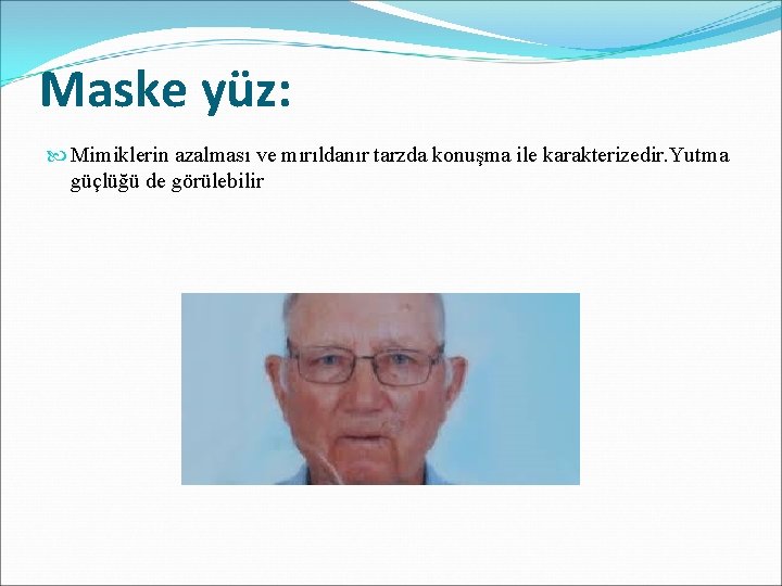 Maske yüz: Mimiklerin azalması ve mırıldanır tarzda konuşma ile karakterizedir. Yutma güçlüğü de görülebilir