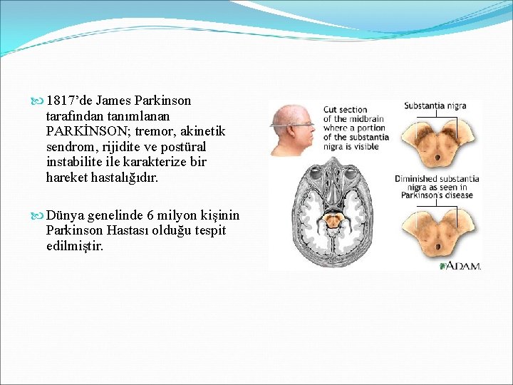  1817’de James Parkinson tarafından tanımlanan PARKİNSON; tremor, akinetik sendrom, rijidite ve postüral instabilite