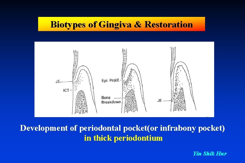 Biotypes of Gingiva & Restoration Development of periodontal pocket(or infrabony pocket) in thick periodontium