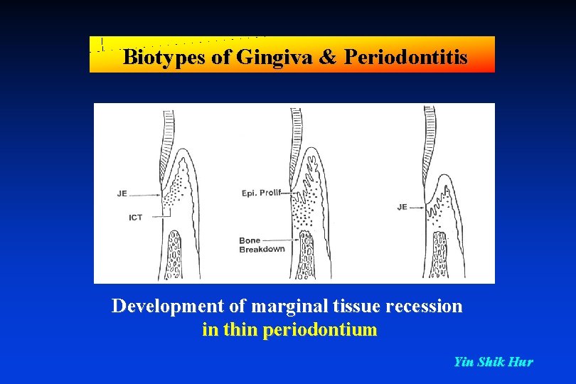 Biotypes of Gingiva & Periodontitis Development of marginal tissue recession in thin periodontium Yin