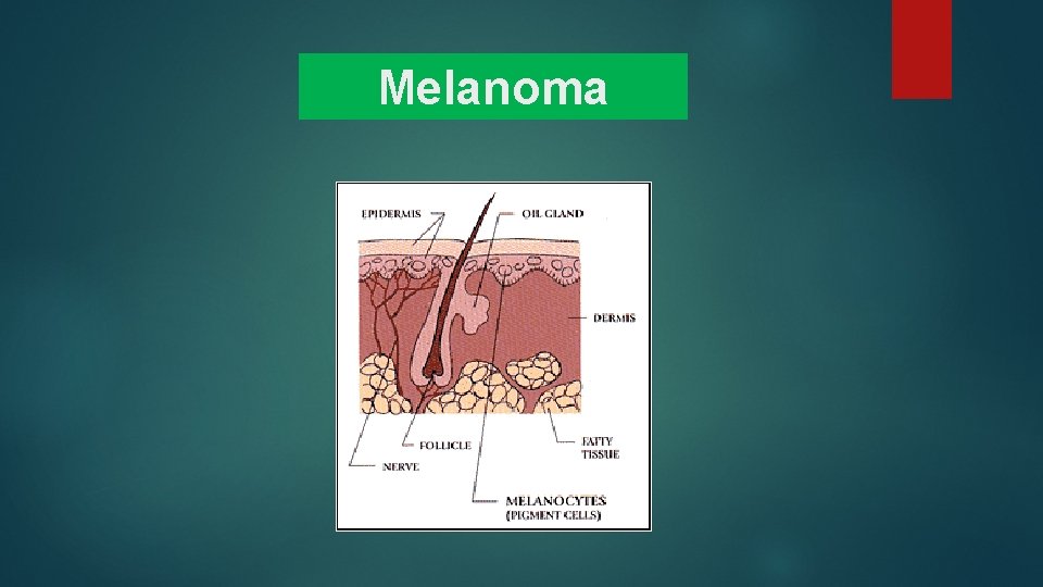 Melanoma Melanoma
