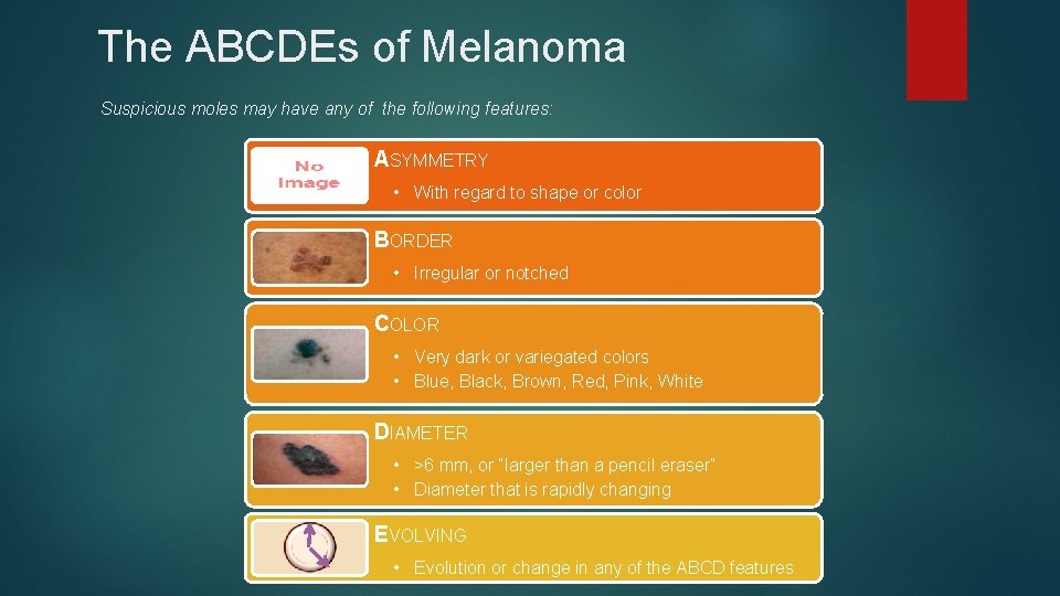 The ABCDEs of Melanoma Suspicious moles may have any of the following features: ASYMMETRY The ABCDEs of Melanoma Suspicious moles may have any of the following features: ASYMMETRY