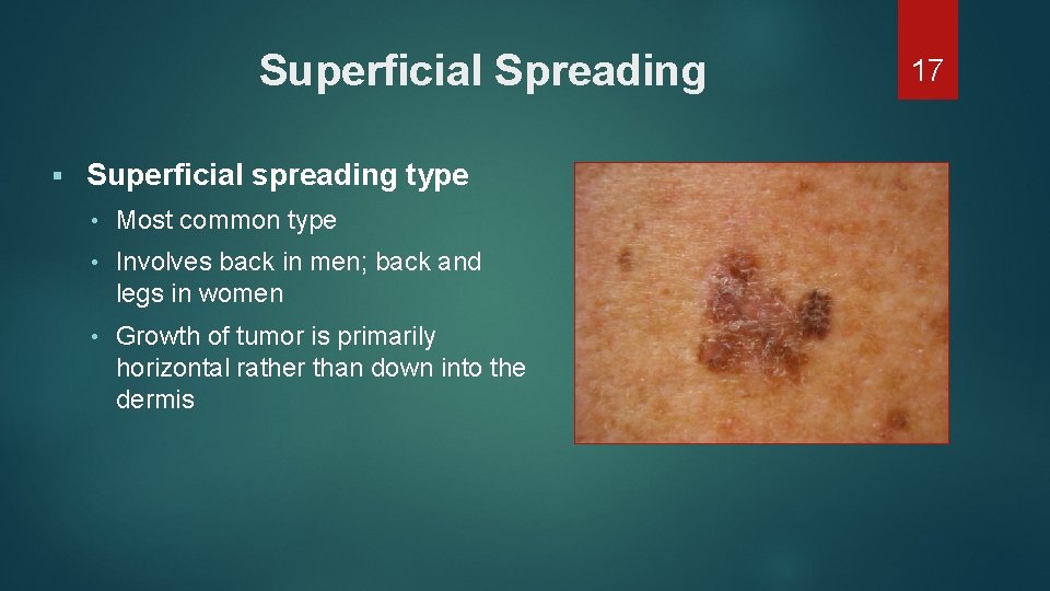 Superficial Spreading § Superficial spreading type • Most common type • Involves back in Superficial Spreading § Superficial spreading type • Most common type • Involves back in