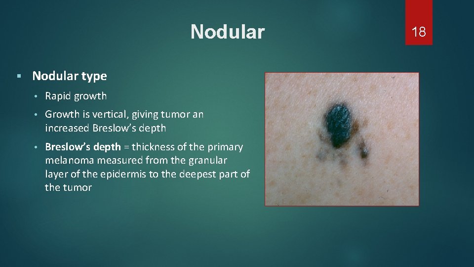 Nodular § Nodular type • Rapid growth • Growth is vertical, giving tumor an Nodular § Nodular type • Rapid growth • Growth is vertical, giving tumor an