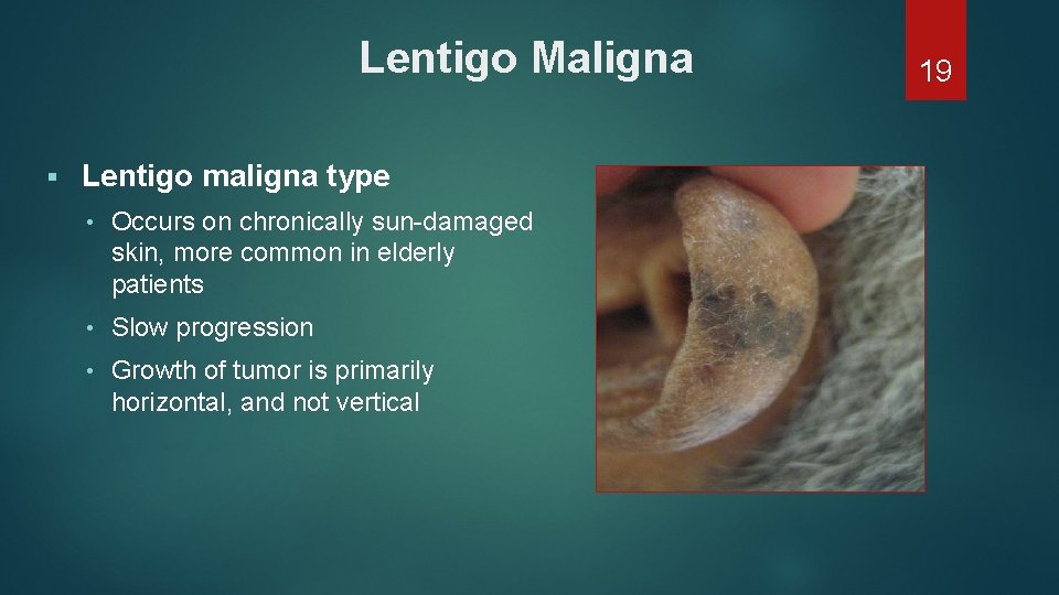 Lentigo Maligna § Lentigo maligna type • Occurs on chronically sun-damaged skin, more common Lentigo Maligna § Lentigo maligna type • Occurs on chronically sun-damaged skin, more common