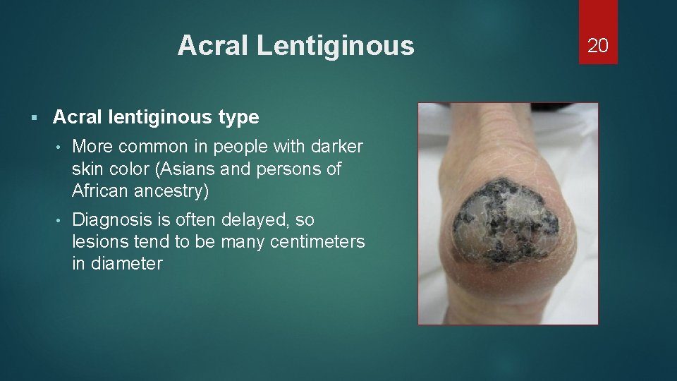 Acral Lentiginous § Acral lentiginous type • More common in people with darker skin Acral Lentiginous § Acral lentiginous type • More common in people with darker skin