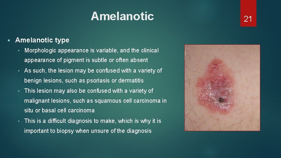 Amelanotic § Amelanotic type • Morphologic appearance is variable, and the clinical appearance of Amelanotic § Amelanotic type • Morphologic appearance is variable, and the clinical appearance of