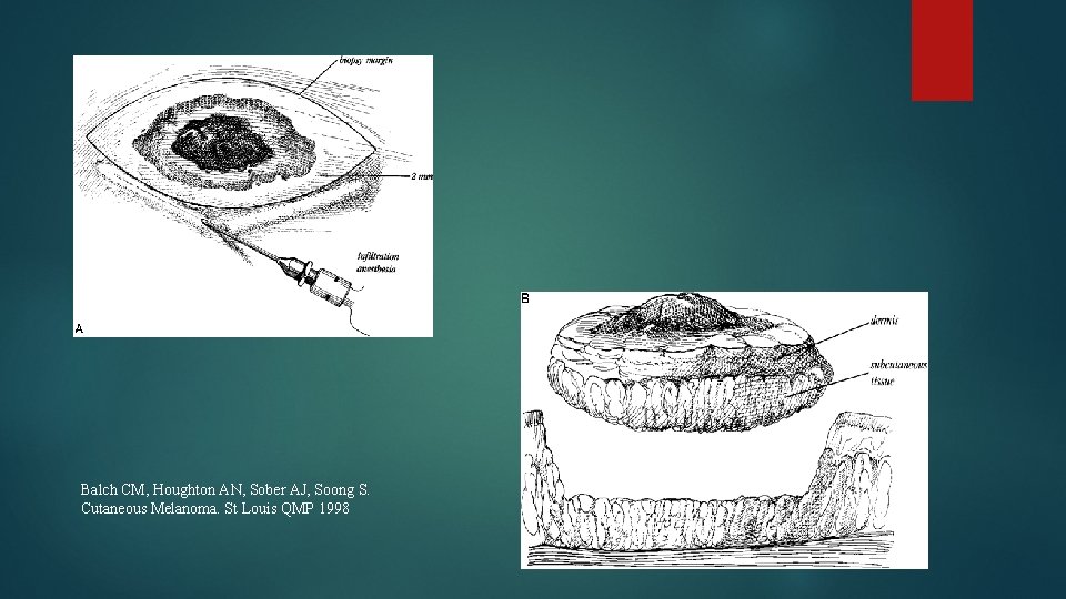 Balch CM, Houghton AN, Sober AJ, Soong S. Cutaneous Melanoma. St Louis QMP 1998 Balch CM, Houghton AN, Sober AJ, Soong S. Cutaneous Melanoma. St Louis QMP 1998