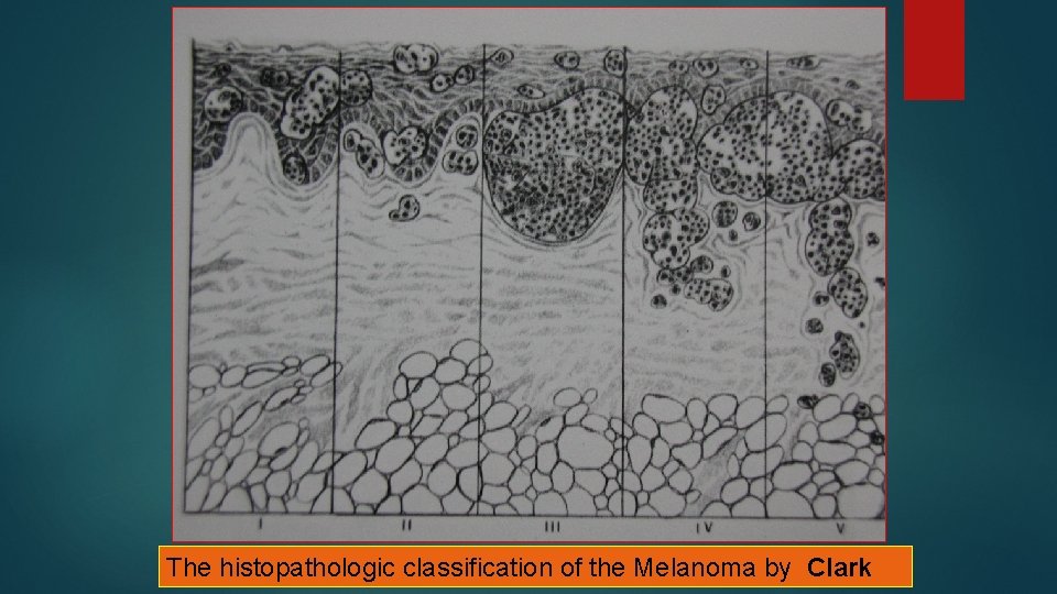 The histopathologic classification of the Melanoma by Clark The histopathologic classification of the Melanoma by Clark