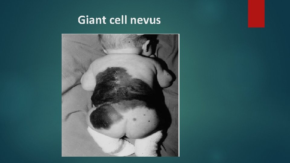 Giant cell nevus Giant cell nevus