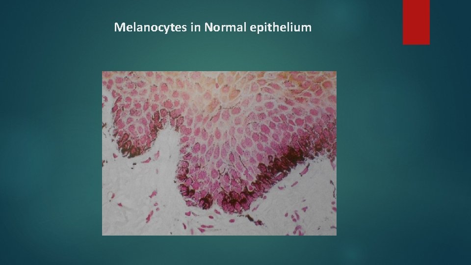 Melanocytes in Normal epithelium Melanocytes in Normal epithelium