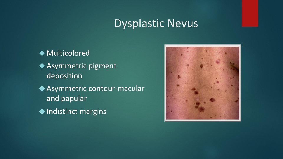 Dysplastic Nevus Multicolored Asymmetric pigment deposition Asymmetric contour-macular and papular Indistinct margins Dysplastic Nevus Multicolored Asymmetric pigment deposition Asymmetric contour-macular and papular Indistinct margins
