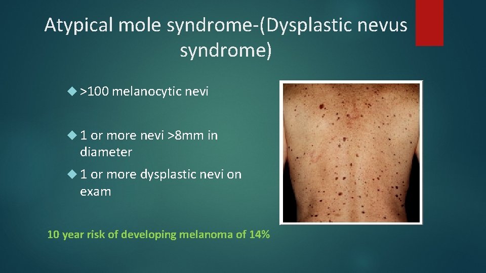 Atypical mole syndrome-(Dysplastic nevus syndrome) >100 melanocytic nevi 1 or more nevi >8 mm Atypical mole syndrome-(Dysplastic nevus syndrome) >100 melanocytic nevi 1 or more nevi >8 mm
