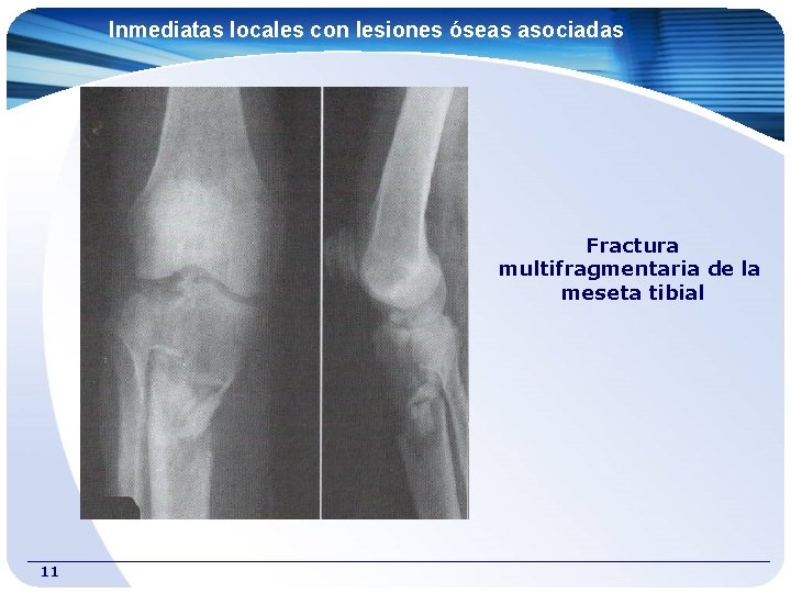 Inmediatas locales con lesiones óseas asociadas Fractura multifragmentaria de la meseta tibial 11 