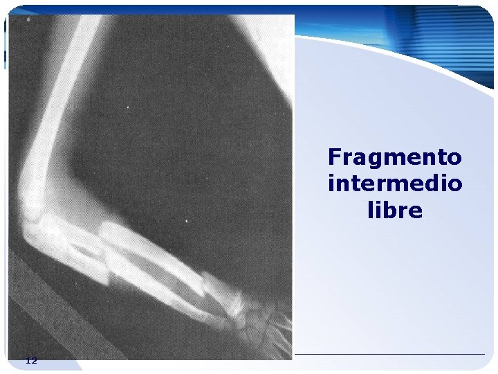 Fragmento intermedio libre 12 