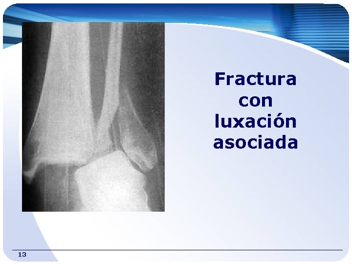Fractura con luxación asociada 13 
