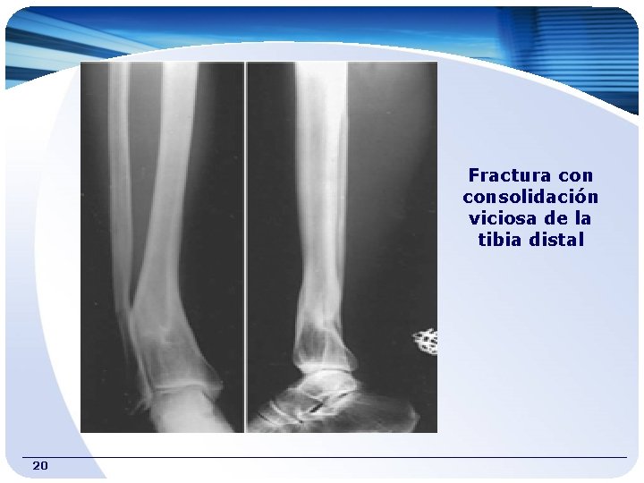 Fractura consolidación viciosa de la tibia distal 20 